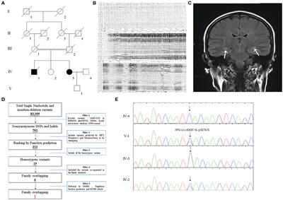 Case Report: Chorea-Acanthocytosis Presents as Epilepsy in a Consanguineous Family With a Nonsense Mutation of in VPS13A